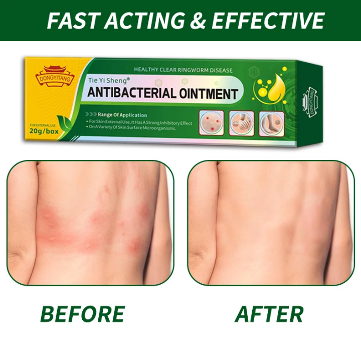Découvrez Tie Yi Sheng® – Crème Antibactérienne Naturelle 🌿